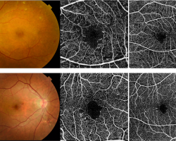 Damage in superficial capillary plexus in eyes with DR captured by optical coherence tomography angiography. Image courtesy of Dr Carol Y. Cheung from Department of Ophthalmology and Visual Sciences, The Chinese University of Hong Kong.
