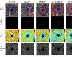 Quantitative optical coherence tomography angiography analysis to study DR severity. Image courtesy of Dr Carol Y. Cheung from Department of Ophthalmology and Visual Sciences, The Chinese University of Hong Kong.