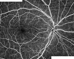 Wide-field optical coherence tomography angiography. Image courtesy of Dr Carol Y. Cheung from Department of Ophthalmology and Visual Sciences, The Chinese University of Hong Kong.