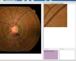 Quantitative retinal vasculature analysis using Singapore I Vessel Assessment (SIVA) software. Image courtesy of Dr Carol Y. Cheung from Department of Ophthalmology and Visual Sciences, The Chinese University of Hong Kong.