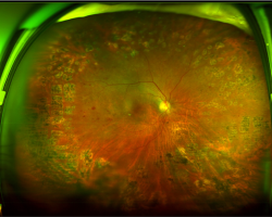 Laser scar after photocoagulation in an eye with diabetic retinopathy capture by ultra-widefield retinal imaging. Image courtesy of Dr Carol Y. Cheung from Department of Ophthalmology and Visual Sciences, The Chinese University of Hong Kong.