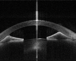 An eye with peripheral anterior synechia (PAS) captured by anterior-segment swept-source OCT. Image courtesy of Prof Clement Tham from Department of Ophthalmology and Visual Sciences, The Chinese University of Hong Kong.