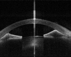 An eye with peripheral anterior synechia (PAS) captured by anterior-segment swept-source OCT. Image courtesy of Prof Clement Tham from Department of Ophthalmology and Visual Sciences, The Chinese University of Hong Kong.