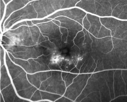 An eye with diabetic macular edema captured by florescence angiography. Image courtesy of Dr Carol Cheung from Department of Ophthalmology and Visual Sciences, The Chinese University of Hong Kong.