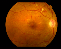An eye with nonproliferative diabetic retinopathy captured by fundus photography. Image courtesy of Dr Carol Cheung from Department of Ophthalmology and Visual Sciences, The Chinese University of Hong Kong.