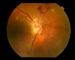 An eye with proliferative diabetic retinopathy captured by fundus photography. Image courtesy of Dr Carol Cheung from Department of Ophthalmology and Visual Sciences, The Chinese University of Hong Kong.