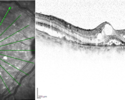 An eye with diabetic macular edema captured by spectral-domain OCT. Image courtesy of Dr Carol Y. Cheung from Department of Ophthalmology and Visual Sciences, The Chinese University of Hong Kong.