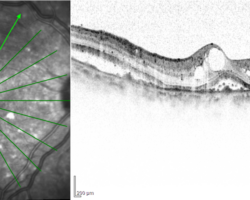 An eye with diabetic macular edema captured by spectral-domain OCT. Image courtesy of Dr Carol Y. Cheung from Department of Ophthalmology and Visual Sciences, The Chinese University of Hong Kong.