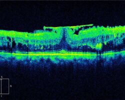 An eye with epiretinal membrane captured by spectral-domain OCT. Image courtesy of Dr Carol Y. Cheung from Department of Ophthalmology and Visual Sciences, The Chinese University of Hong Kong.