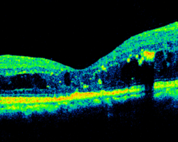 An eye with diabetic macular edema captured by spectral-domain OCT. Image courtesy of Dr Carol Y. Cheung from Department of Ophthalmology and Visual Sciences, The Chinese University of Hong Kong.