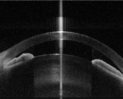 An eye with shallow anterior chamber and narrow angles captured by anterior-segment swept-source OCT. Image courtesy of Prof Clement Tham from Department of Ophthalmology and Visual Sciences, The Chinese University of Hong Kong.