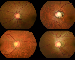 Eyes with glaucoma captured by fundus photography. Image courtesy of Dr Carol Y. Cheung from Department of Ophthalmology and Visual Sciences, The Chinese University of Hong Kong.